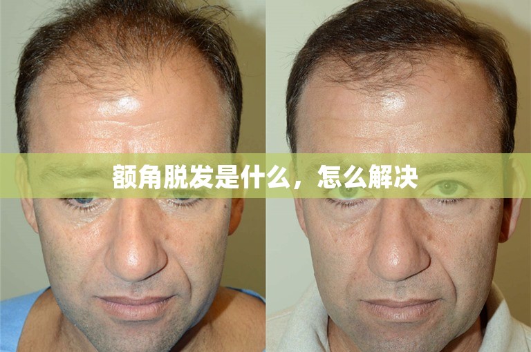 额角脱发是什么,怎么解决 额角脱发是什么,怎么解决