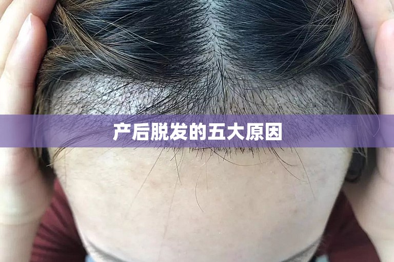 产后脱发的五大原因