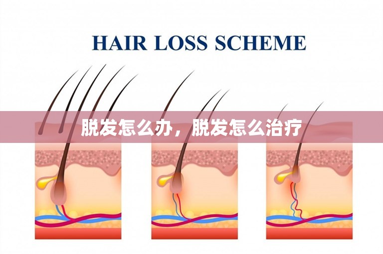 脱发怎么办,脱发怎么治疗 脱发怎么办,脱发怎么治疗