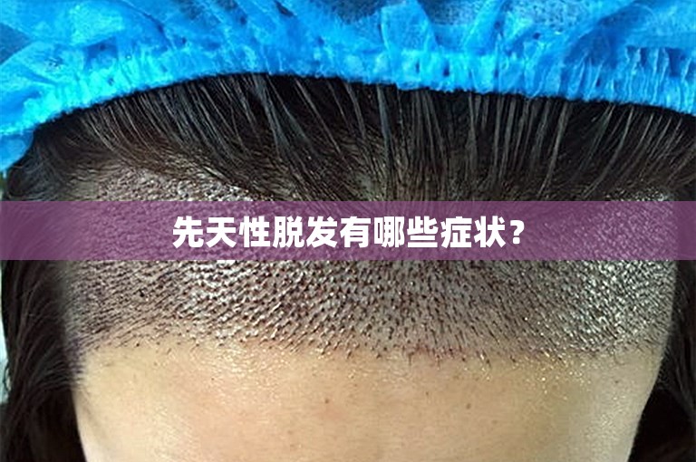 先天性脱发有哪些症状？