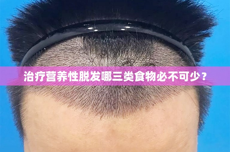 治疗营养性脱发哪三类食物必不可少？