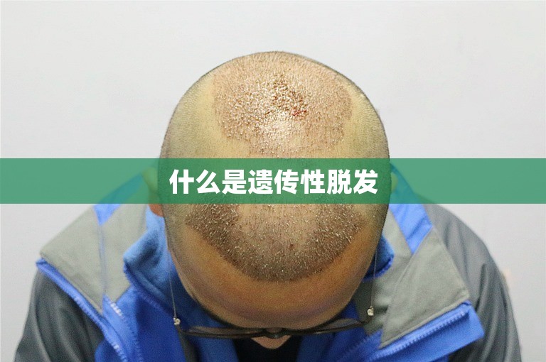 什么是遗传性脱发