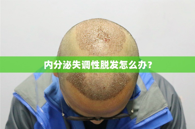 内分泌失调性脱发怎么办？