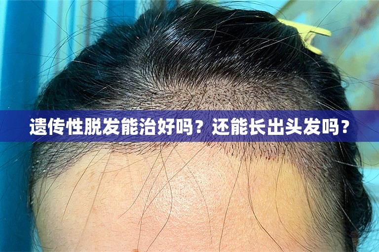 遗传性脱发能治好吗？还能长出头发吗？