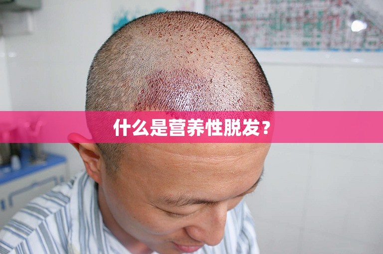 什么是营养性脱发？