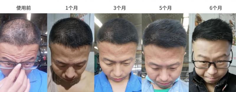 十年脱发，用米诺地尔和增效，两个月就能长回来？!