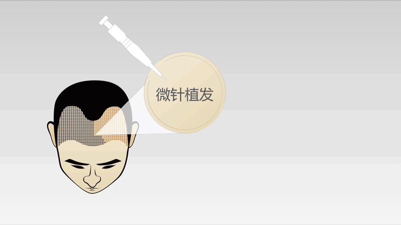 大麦微针植发：植发效果不理想，到底是哪些导致的？