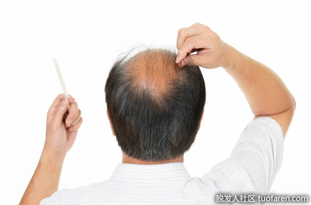 如何自然治疗脱发