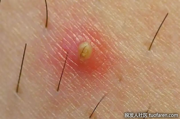 毛发内生的5种天然解方