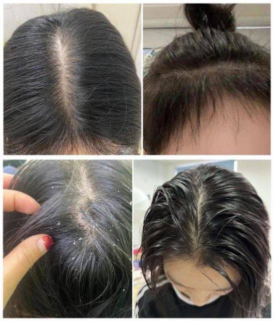 千万别让你的女朋友碰这些洗发水成分，除非你想让她从脱发、扁塌、头屑、头痒逆袭成发量爆炸、清爽蓬松秀发！