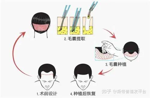 几千的植发和3万的植发有什么区别？植发的价格为什么差那么多？医院医生如何选？植发必看！让你不花冤枉钱