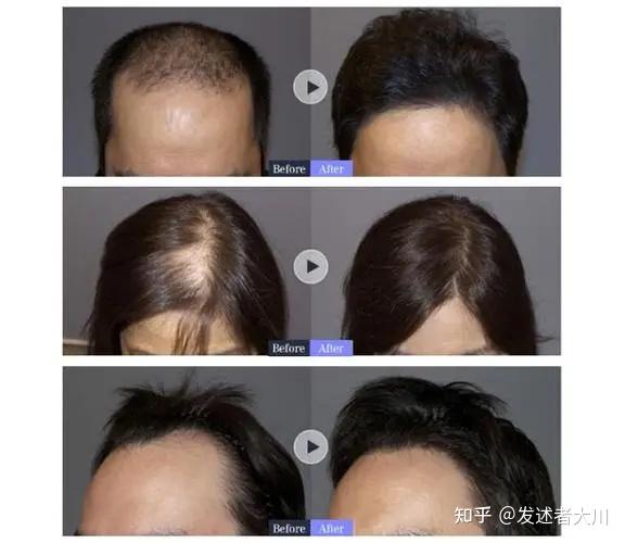 全国植发医院黑/白名单查询系统 - 查植发医生|查植发价格|查植发案例（实时更新）