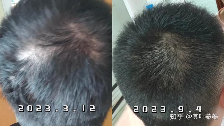 为什么强烈建议掉发非常严重的时候，一定要用含有（侧柏叶）的防脱洗发水！