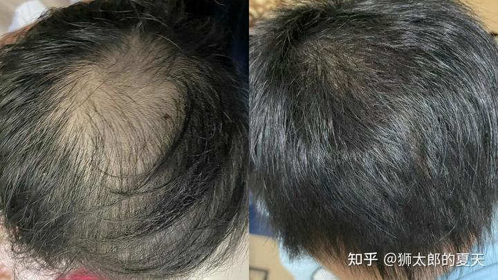 秃头医生自救指南！我们经常喝的瑞幸、星巴克里面的咖啡因竟然能防脱发？欧倍青防脱洗发水真的比米诺地尔还要好用吗？