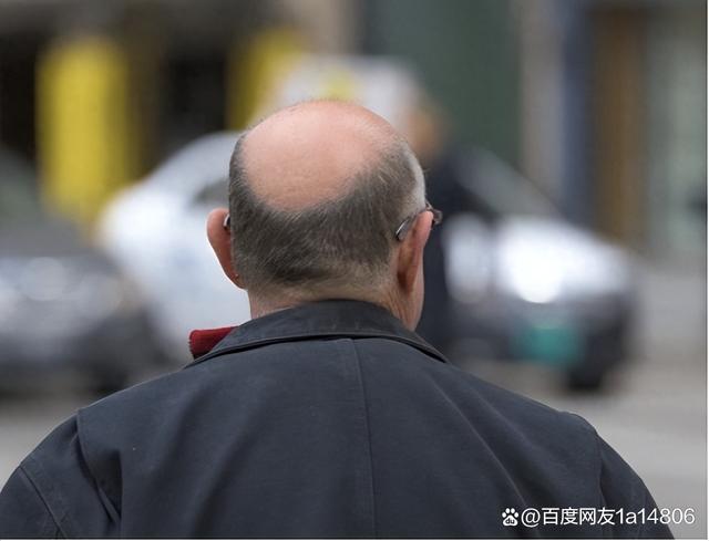 脱发严重，医生教你简单四招，正确搞定掉头发