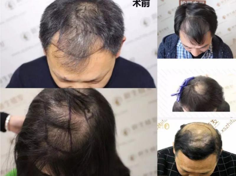 植发活动新生VIP发友回馈盛典