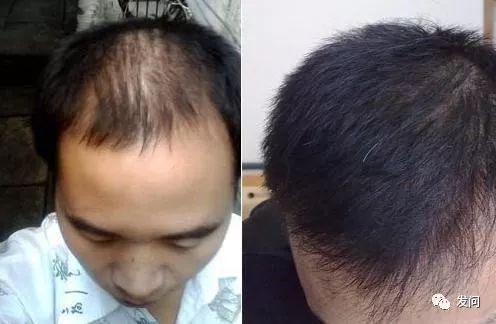 讲述老罗藏着23万脱发人的秘密…