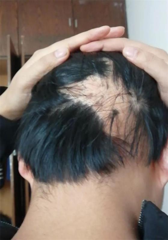 又有2人获免费疤痕植发