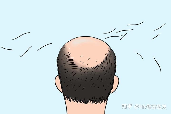 hiv多年，终于植好发了！