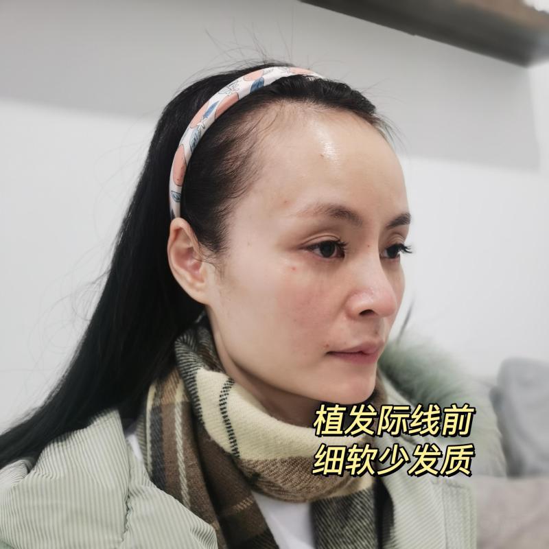 植发真香，这一对比真的有被震惊到