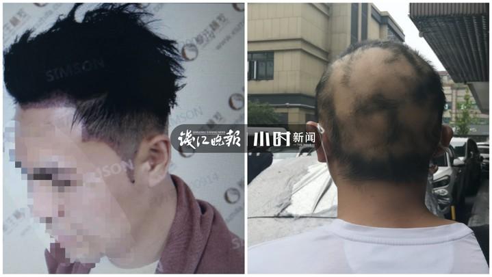 挺“秃”然的……帅小伙花一万多植发，一年后头发没了，工作丢了，女朋友也分手了