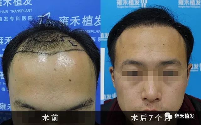 是爸爸植发还是我植发？钱只够一个人
