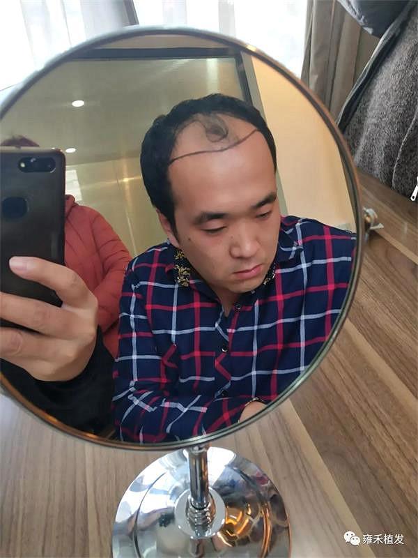 脱发惹的祸！他相亲30次都不成功2019最扎心的新闻