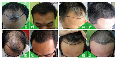 杭州治疗脱发医院植发哪家好