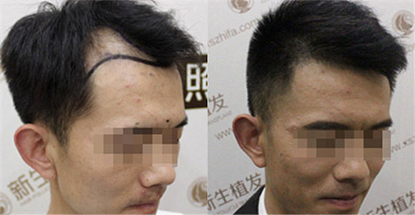 哪家植发医院值得选择