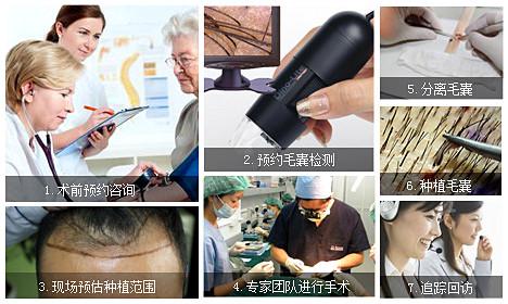 脱发治疗深圳植发医院哪家效果好