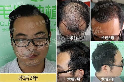 武汉植发医院哪家植发技术好