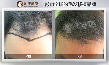 合肥地区什么植发医院好