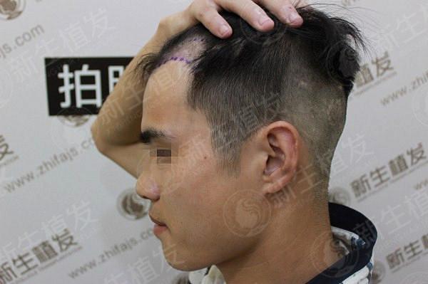 南京哪家医院植发效果比较好