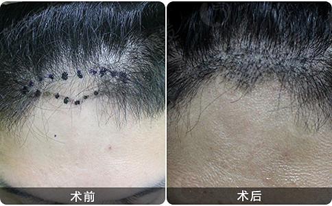 长沙较好植发医院是什么？