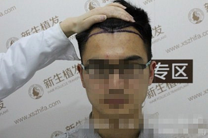 广州植发哪家医院种植的技术好
