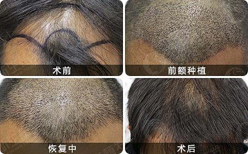 南京新生植发到底怎么样呢？