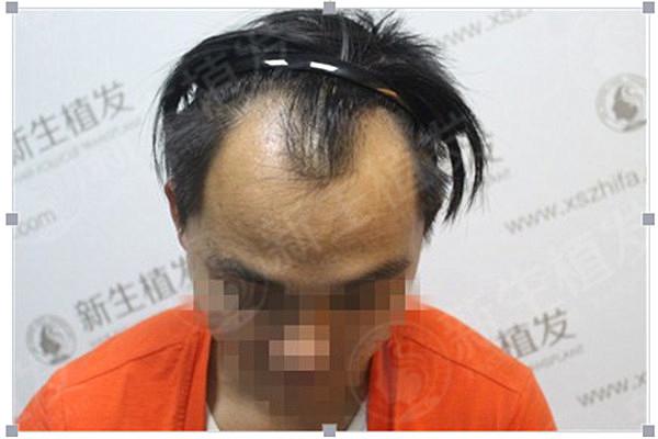 武汉男性植发医院哪家术之后效果好