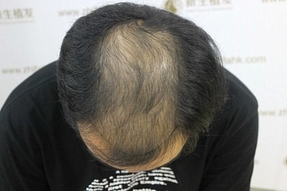 杭州新生植发解决秃顶危机
