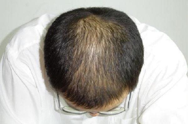 石家庄哪家医院专冶脂溢性脱发
