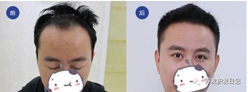 决定植发手术成败的因素