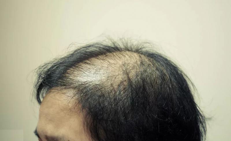 秃顶的人可以植发吗？是时候告诉你真相了