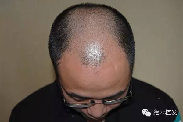异体植发求救信能把朋友的头发移植到我头上吗？
