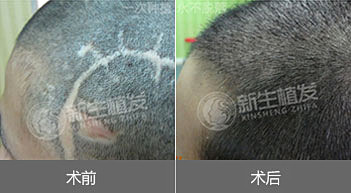 疤植发手术效果好吗
