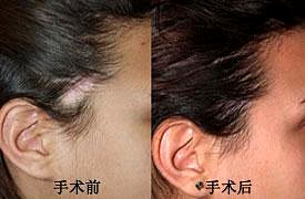 疤种植效果如何