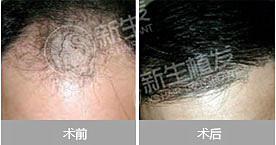 植发真能解决脱发问题吗