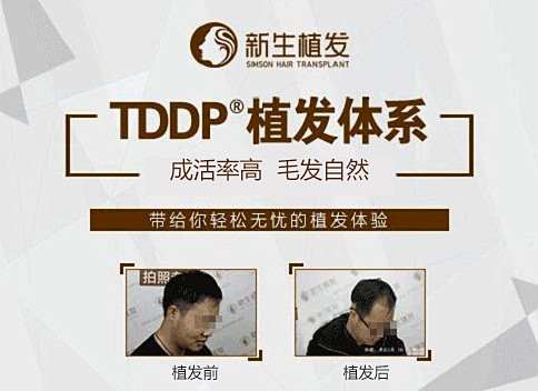 昆明植发靠谱吗