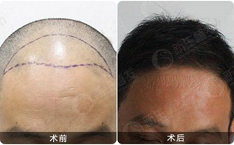 植发的效果会受到什么影响呢？