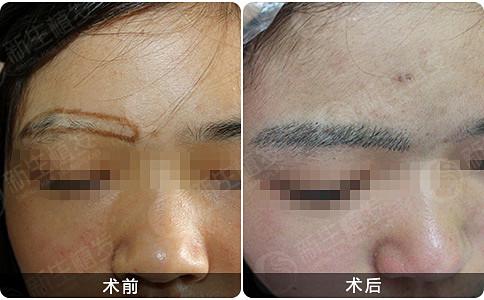 南京新生植发的效果会如何呢？