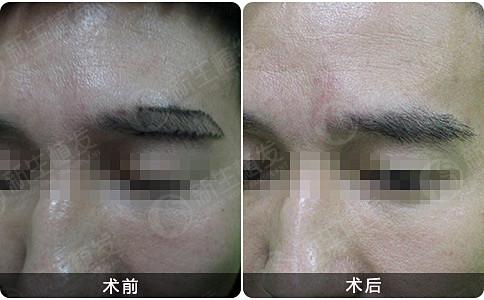 植发效果较多能持续多久？