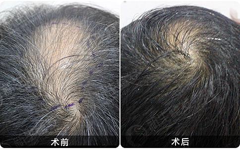 在合肥做植发的效果好吗